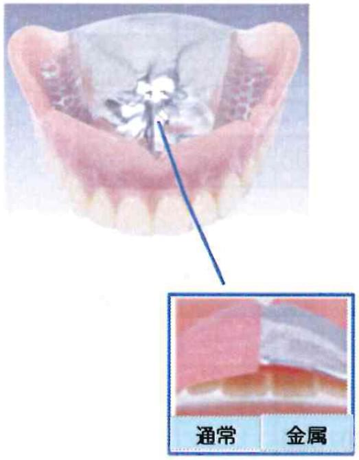 違和感がない金属入れ歯